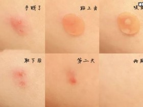 【APL扑克】女生节战“痘”指南,呵护你的美